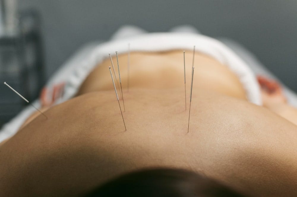 Acupuncture for auto Accident Recovery